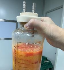桦甸水动力吸脂手术要做多久？